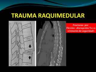 TRAUMA RAQUIMEDULAR 
Fracturas por 
Flexión –disrupción T11-12 
«cinturón de seguridad» 
 