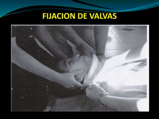 FIJACION DE VALVAS 
 