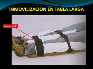 INMOVILIZACION EN TABLA LARGA 
Inadecuado 
 