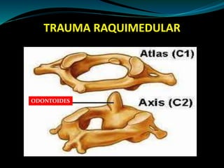 TRAUMA RAQUIMEDULAR 
ODONTOIDES 
 