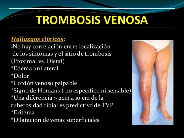 La migliore crema da una posizione di varicosity