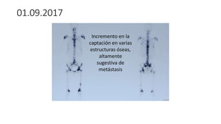 Incremento en la
captación en varias
estructuras óseas,
altamente
sugestiva de
metástasis
01.09.2017
 