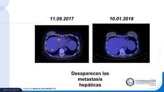 Creado por Mauricio Lema Medina MD
10.01.201811.09.2017
Desaparecen las
metastasis
hepáticas
 