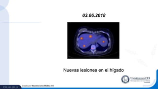Creado por Mauricio Lema Medina MD
03.06.2018
Nuevas lesiones en el hígado
 
