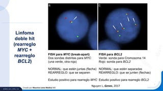 Creado por Mauricio Lema Medina MD
Nguyen L, Genes, 2017
Linfoma
doble hit
(rearreglo
MYC +
rearreglo
BCL2)
FISH para MYC (break-apart)
Dos sondas distintas para MYC
(una verde, otra roja)
NORMAL: que estén juntas (flecha)
REARREGLO: que se separen
Estudio positivo para rearreglo MYC
FISH para BCL2
Verde: sonda para Cromosoma 14
Rojo: sonda para BCL2
NORMAL: que estén separadas
REARREGLO: que se junten (flechas)
Estudio positivo para rearreglo BCL2
 