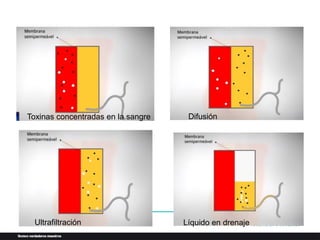 Difusión
Ultrafiltración Líquido en drenaje
Toxinas concentradas en la sangre
 
