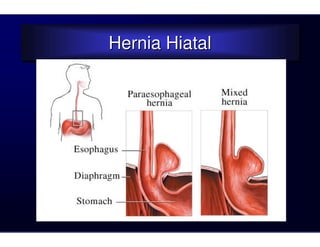 Hernia Hiatal
Hernia Hiatal
 