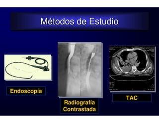 Métodos de Estudio
         Métodos de Estudio




Endoscopía
                              TAC
              Radiografía
              Contrastada
 