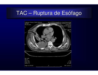 TAC – Ruptura de Esófago
TAC – Ruptura de Esófago
 