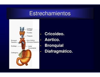 Estrechamientos
Estrechamientos


   •   Cricoideo.
   •   Aortico.
   •   Bronquial
   •   Diafragmático.
 