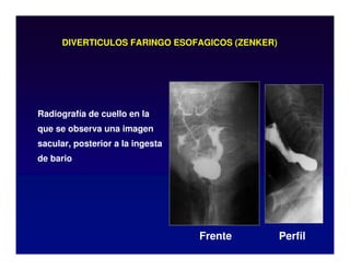 DIVERTICULOS FARINGO ESOFAGICOS (ZENKER)
Radiografía de cuello en la
que se observa una imagen
sacular, posterior a la ingesta
de bario
Frente Perfil
 