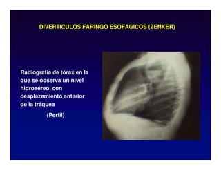 DIVERTICULOS FARINGO ESOFAGICOS (ZENKER)
Radiografía de tórax en la
que se observa un nivel
hidroaéreo, con
desplazamiento anterior
de la tráquea
(Perfil)
 