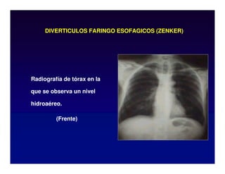 DIVERTICULOS FARINGO ESOFAGICOS (ZENKER)
Radiografía de tórax en la
que se observa un nivel
hidroaéreo.
(Frente)
 