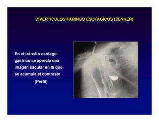 DIVERTICULOS FARINGO ESOFAGICOS (ZENKER)
En el tránsito esófago-
gástrico se aprecia una
imagen sacular en la que
se acumula el contraste
(Perfil)
 