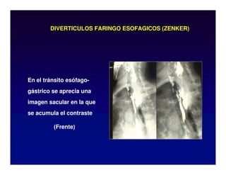 DIVERTICULOS FARINGO ESOFAGICOS (ZENKER)
En el tránsito esófago-
gástrico se aprecia una
imagen sacular en la que
se acumula el contraste
(Frente)
 