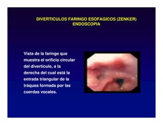 DIVERTICULOS FARINGO ESOFAGICOS (ZENKER)
ENDOSCOPIA
Vista de la faringe que
muestra el orificio circular
del divertículo, a la
derecha del cual está la
entrada triangular de la
tráquea formada por las
cuerdas vocales.
 