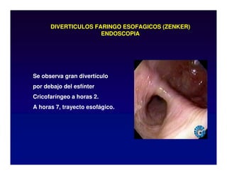 DIVERTICULOS FARINGO ESOFAGICOS (ZENKER)
ENDOSCOPIA
Se observa gran divertículo
por debajo del esfínter
Cricofaríngeo a horas 2.
A horas 7, trayecto esofágico.
 
