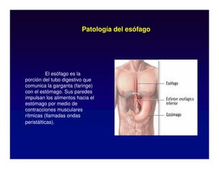 Patología del esófago
El esófago es la
porción del tubo digestivo que
comunica la garganta (faringe)
con el estómago. Sus paredes
impulsan los alimentos hacia el
estómago por medio de
contracciones musculares
rítmicas (llamadas ondas
peristálticas).
 