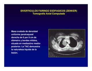 DIVERTICULOS FARINGO ESOFAGICOS (ZENKER)
Tomografía Axial Computada
Masa ovalada de densidad
uniforme paratraqueal
derecha de 6 por 9 cm de
diámetro y bordes nítidos,
situada en mediastino medio-
posterior. La TAC demuestra
la naturaleza líquida de la
lesión.
 