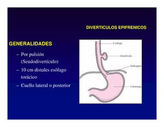 DIVERTICULOS EPIFRENICOS
GENERALIDADES
– Por pulsión
(Seudodivertículo)
– 10 cm distales esófago
torácico
– Cuello lateral o posterior
 