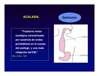 ACALASIA
“Trastorno motor
esofágico caracterizado
por ausencia de ondas
peristálticas en el cuerpo
del esófago y una mala
relajación del EEI.”
Ellis y Olsen, 1969
Definición
 