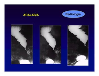 ACALASIA Radiología
 