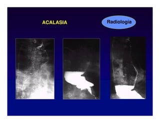 ACALASIA Radiología
 
