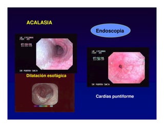 ACALASIA
Dilatación esofágica
Cardias puntiforme
Endoscopia
 