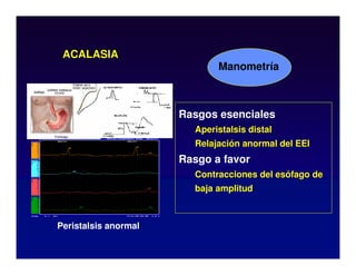 ACALASIA
Manometría
Rasgos esenciales
Aperistalsis distal
Relajación anormal del EEI
Rasgo a favor
Contracciones del esófago de
baja amplitud
Peristalsis anormal
 
