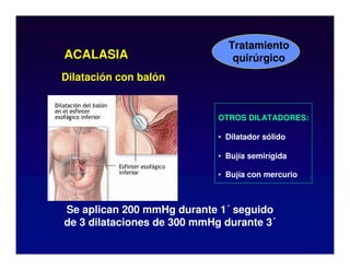 Se aplican 200 mmHg durante 1´ seguido
de 3 dilataciones de 300 mmHg durante 3´
ACALASIA
Tratamiento
quirúrgico
Dilatación con balón
OTROS DILATADORES:
• Dilatador sólido
• Bujía semirígida
• Bujía con mercurio
 