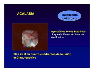 Inyección de Toxina Botulínica:
bloquea la liberación local de
acetilcolina
ACALASIA Tratamiento
quirúrgico
20 a 25 U en cuatro cuadrantes de la unión
esófago-gástrica
 