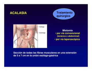 Tratamiento
quirúrgico
ACALASIA
Miotomía
• por vía convencional
(torácica o abdominal)
• por vía laparoscópica
Sección de todas las fibras musculares en una extensión
de 5 a 7 cm en la unión esófago-gástrica
 