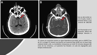 CASO CLINICO
• Masculino de 62 años sin antecedentes médicos significativos se derrumbó en
su baño. El ruido alertó a su hijo, que encontró a su padre en el suelo, mudo e
incapaz de mover el lado derecho de su cuerpo. Inmediatamente llamó a una
ambulancia. Los paramédicos cuantificaron una presión arterial de 180/100
mm Hg y un pulso irregular.
En el departamento de emergencias, el paciente presentaba una fluctuación en el
estado de alerta, desviación forzada de la mirada hacia la izquierda, déficit del
campo visual derecho, afasia global con mutismo, hemiplejía derecha e
hipoestesia derecha severa. Su puntaje NIHSS fue de 22.
TC cráneo sin contraste mostró un signo hiperdenso de ACMI, pero su ASPECT fue
de 10. La Angio-TC mostró una brecha con ausencia flujo ACMI con un buen flujo
colateral distal a ella. La trombólisis intravenosa se inició 55 minutos después del
inicio de los síntomas, y el paciente fue llevado a la sala de angiografía para
terapia endovascular.
 