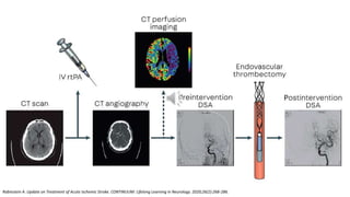Rabinstein A. Update on Treatment of Acute Ischemic Stroke. CONTINUUM: Lifelong Learning in Neurology. 2020;26(2):268-286.
 