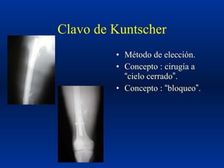 Clase fx diafisis femur2 | PPT