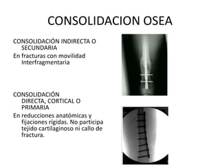 CONSOLIDACION OSEA<br />CONSOLIDACIÓN INDIRECTA O SECUNDARIA<br />En fracturas con movilidad Interfragmentaria<br />CONSOL...