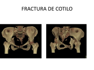 FRACTURA DE COTILO,[object Object]