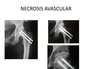 NECROSIS AVASCULAR,[object Object]