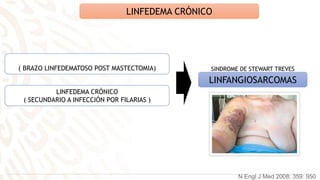 LINFEDEMA CRÓNICO
LINFANGIOSARCOMAS
( BRAZO LINFEDEMATOSO POST MASTECTOMIA)
LINFEDEMA CRÓNICO
( SECUNDARIO A INFECCIÓN POR FILARIAS )
SINDROME DE STEWART TREVES
N Engl J Med 2008; 359: 950
 