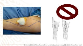 DeVita et al (2018). Soft tissue Sarcoma. Cancer principles & practice of oncology (11 ed). USA: Wolters Kluwer Health
 