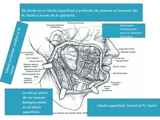 Se divide en un lóbulo superficial o profundo de acuerdo al trayecto del
                             N. facial a través de la glándula:

                                                                                          Importante
                                                                                          consideración
                   l N.


                                                                                          para la resección
                         a



                                                                                          quirúrgica
                    dial
              o: me
facia profund
      lo
     l
 Lóbu




                             La mayor parte
                             de los tumores
                             benignos están
                             en el lóbulo                                  Lóbulo superficial: lateral al N. facial
                             superficial.
 