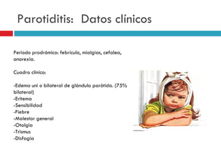 Parotiditis: Datos clínicos

Periodo prodrómico: febrícula, mialgias, cefalea,
anorexia.

Cuadro clínico:

-Edema uni o bilateral de glándula parótida. (75%
bilateral)
-Eritema
-Sensibilidad
-Fiebre
-Malestar general
-Otalgia
-Trismus
-Disfagia
 