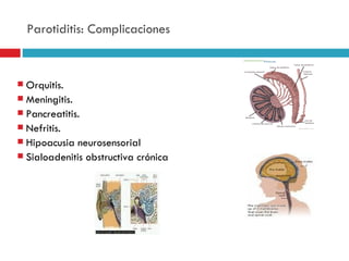 Parotiditis: Complicaciones


 Orquitis.
 Meningitis.
 Pancreatitis.
 Nefritis.
 Hipoacusia neurosensorial
 Sialoadenitis obstructiva crónica
 