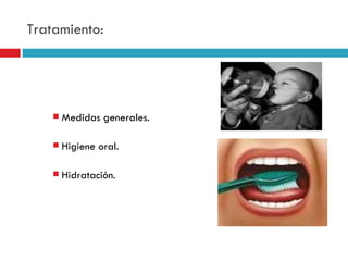 Tratamiento:




       Medidas generales.

       Higiene oral.

       Hidratación.
 