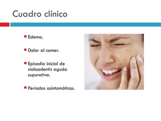 Cuadro clínico

     Edema.

     Dolor al comer.

     Episodio inicial de
      sialoadentis aguda
      supurativa.

     Períodos asintomáticos.
 