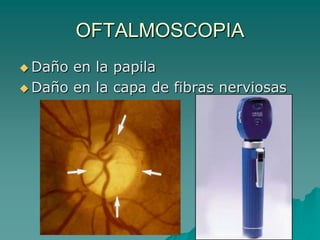 OFTALMOSCOPIA
 Daño en la papila
 Daño en la capa de fibras nerviosas
 