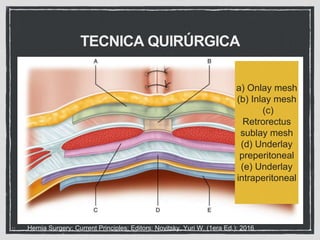 Sublay Retrorectus HERNIA VENTRAL PRIMARIA, INCISIONAL.pptx