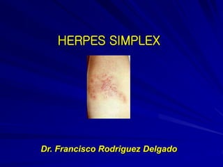 HERPES SIMPLEX
Dr. Francisco Rodriguez Delgado
 