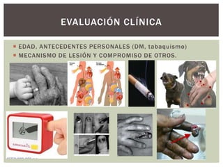 EVALUACIÓN CLÍNICA

 EDAD, ANTECEDENTES PERSONALES (DM, tabaquismo)
 MECANISMO DE LESIÓN Y COMPROMISO DE OTROS.
 