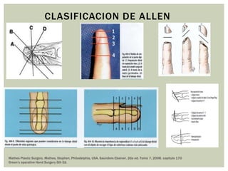 CLASIFICACION DE ALLEN




Mathes Plastic Surgery. Mathes, Stephen. Philadelphia, USA. Saunders Elseiver. 2da ed. Tomo 7. 2008. capitulo 170
Green’s operative Hand Surgery 5th Ed.
 